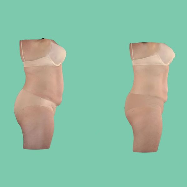 body sculpting

before and after transformation

non-invasive fat reduction

abdominal contouring

