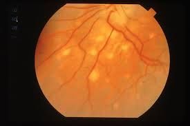 SARCOIDOSIS: THE RETINA INSTITUTE BOARD CERTIFIED RETINAL MICRO-SURGICAL  EYE CARE IN NEW ORLEANS, LA