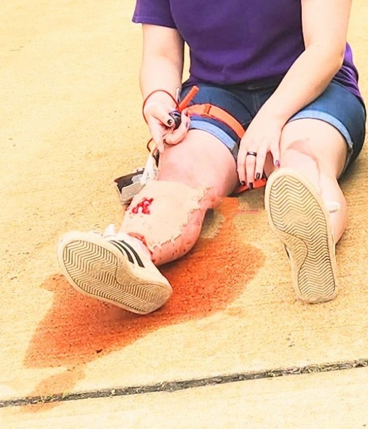 Person sitting on the ground with visible leg injuries and wearing shorts and a purple shirt.