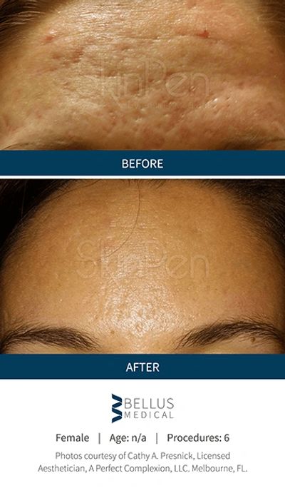 Best Microneedling in Ohio and Pennsylvania. Best skincare and