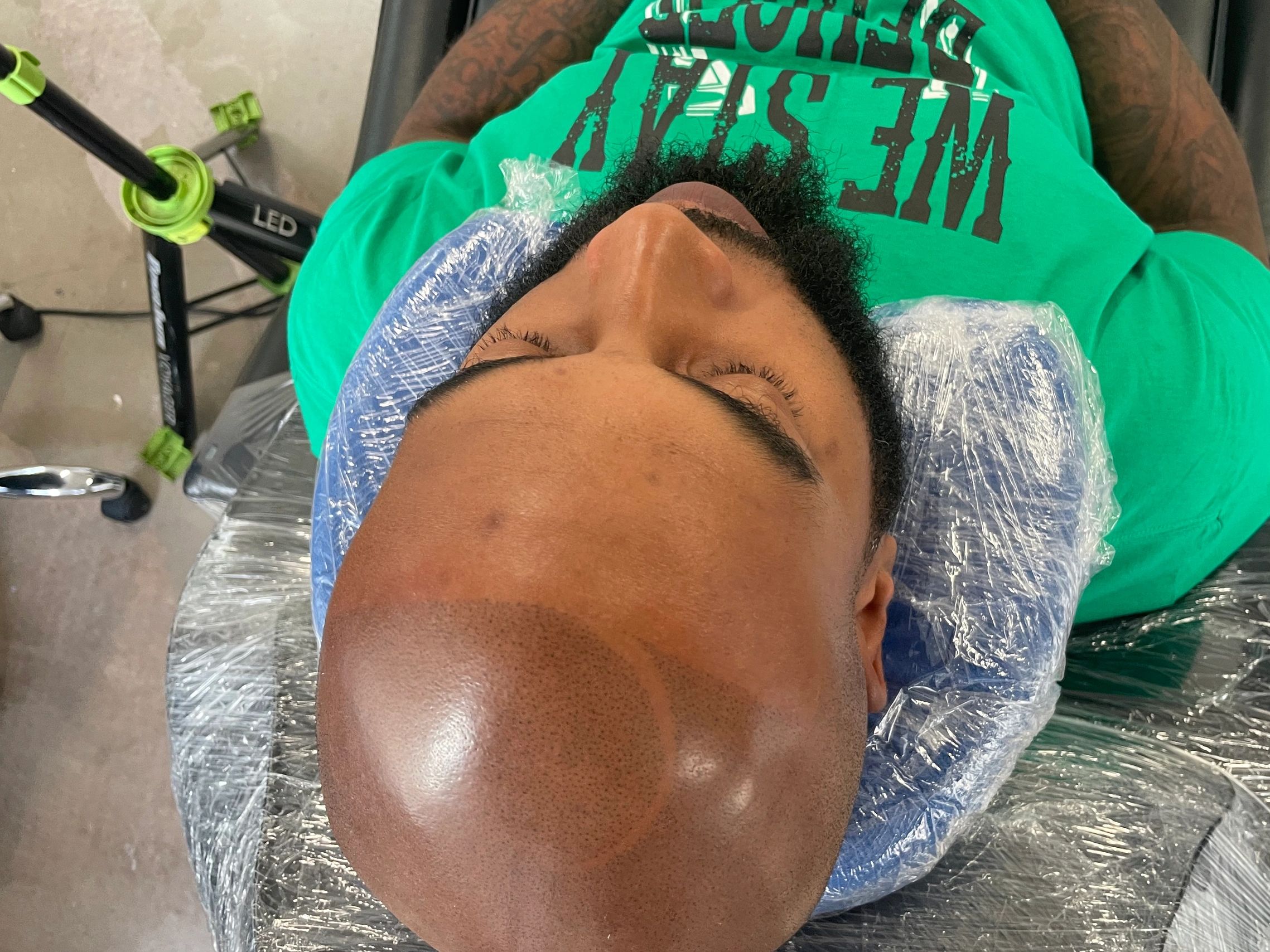 Scalp micropigmentation hair loss solution