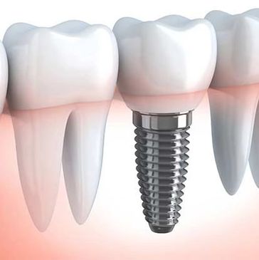 Remplacement d'une dent par un implant dentaire