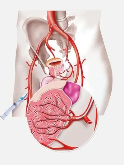 Prostate Artery Embolization (PAE) for Enlarged Prostate (BPH) in Rajkot, India