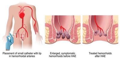 Illustration of hemorrhoid artery embolization procedure and its effect on hemorrhoids.