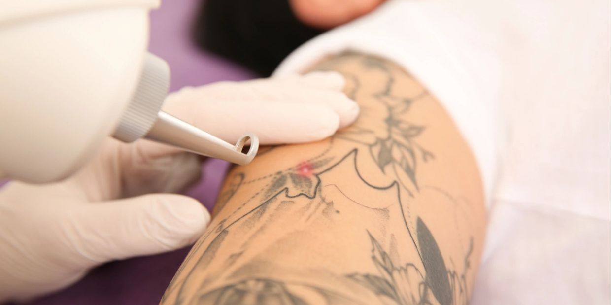 Laser Tattoo Removal