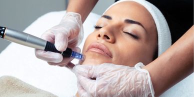Microneedling