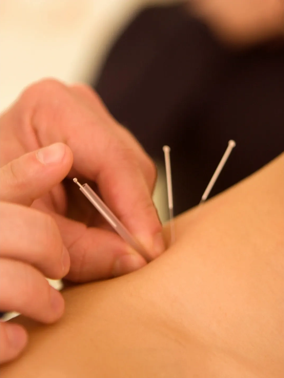 Patient receiving acupuncture (musculoskeletal)