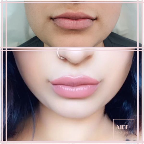 Art of Aesthetics Lip Filler
Cambridge, ON 