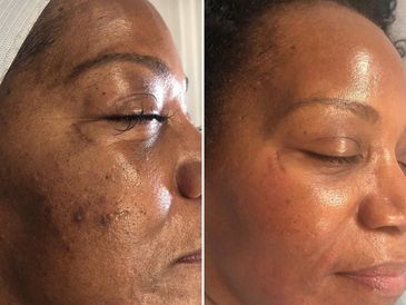 Neo Elite can rejuvenate skin through stimualting, collagen smoothing lines, reducing pores. 