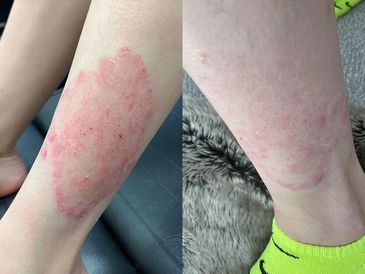 Neo Elite - Psoriasis Treatment