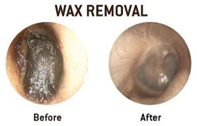 Ear wax removal 