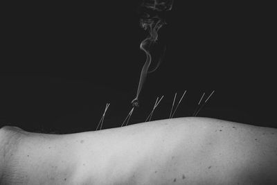 Acupuncture