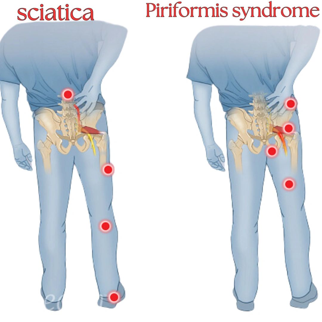 Differences Between Piriformis Syndrome and Sciatica