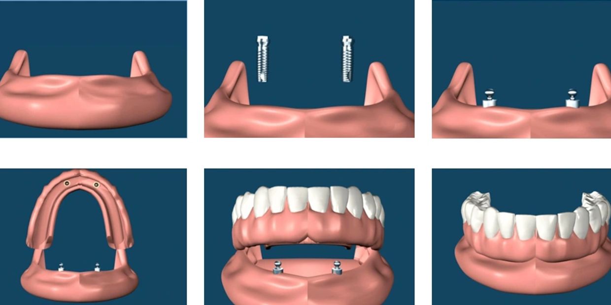 How an implant supported denture works at Dorset Park Denture Clinic