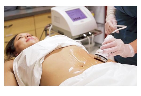 Radiofrequency and Caviation