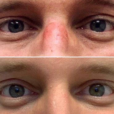 Natural filler for under eye hollows