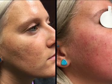 Acne scarring treatment with non-invasive PicoSure 