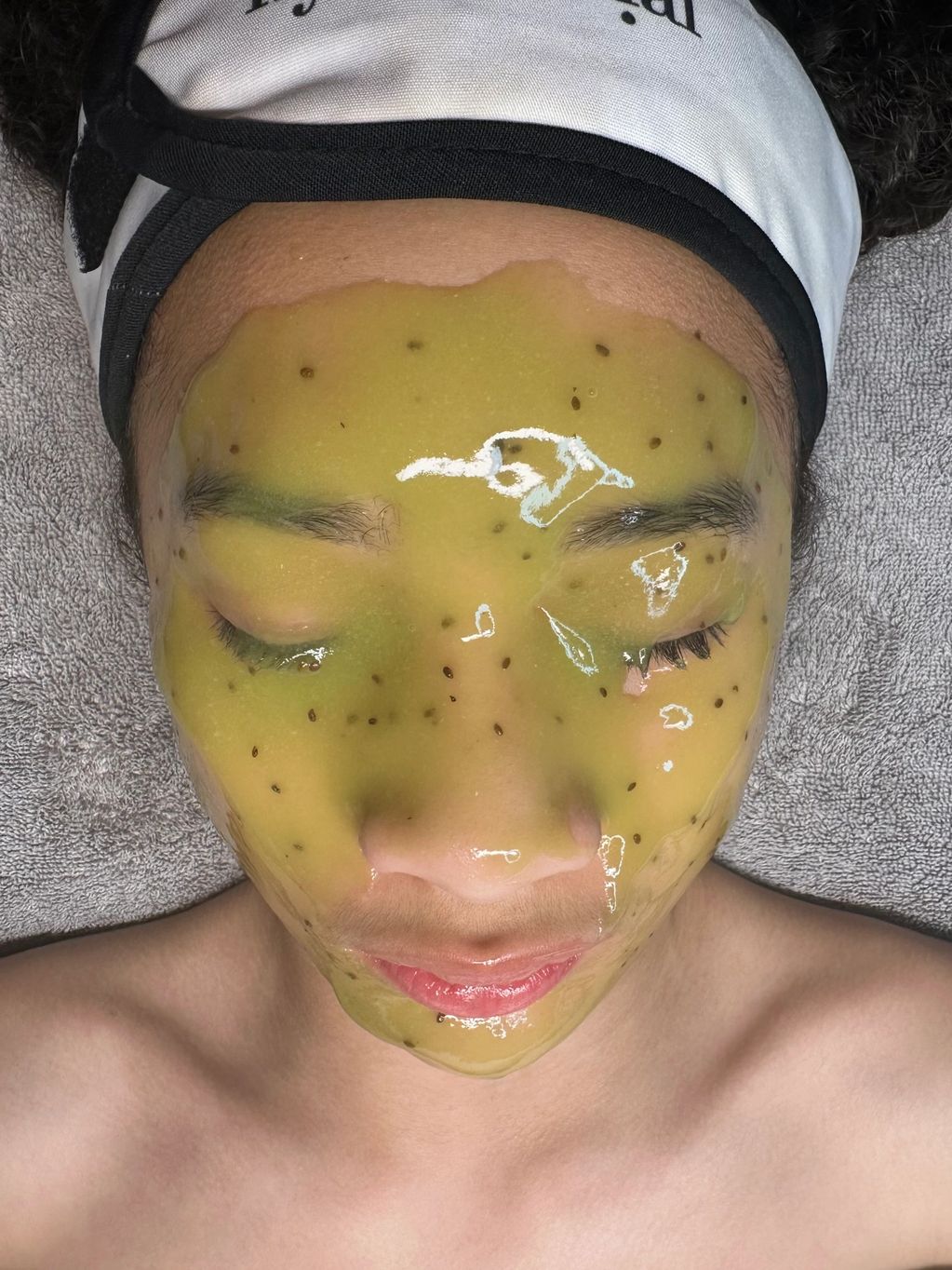 Teen acne facial 