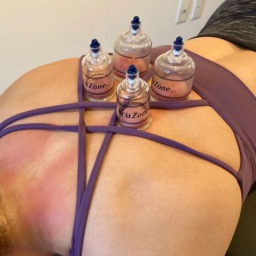 Cupping Therapy Mooresville, NC
