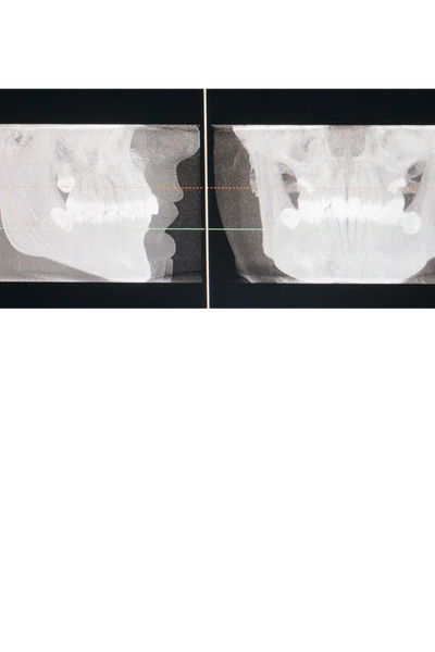 3-D X-Ray (CBCT)