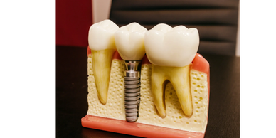 Dental Implants