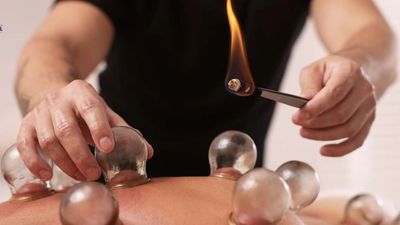 Therapist applying fire cupping therapy on a person's back.