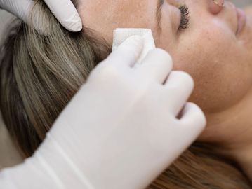 Close up of cleints face in clinic while nurse Cass cleans her skin with a gauze wipe 