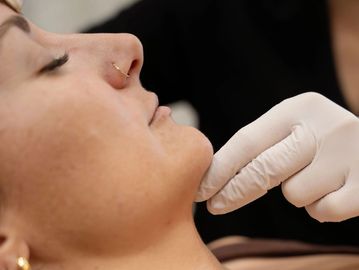 Close up of a clients side of face while nurse Cass supports her chin while eraing sterile gloves
