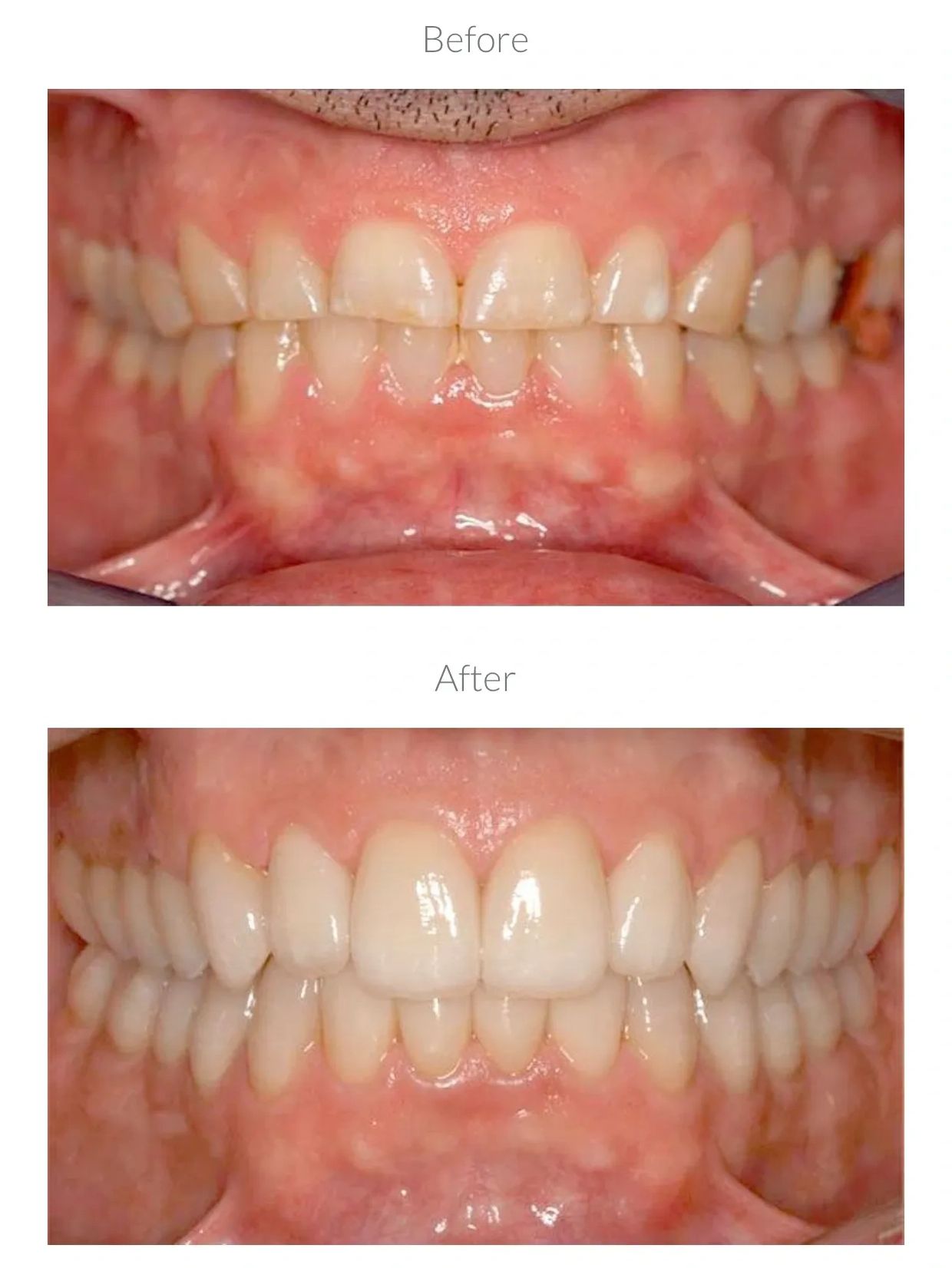 Loss of tooth structure to clenching and grinding is NO different than structural loss to cavities