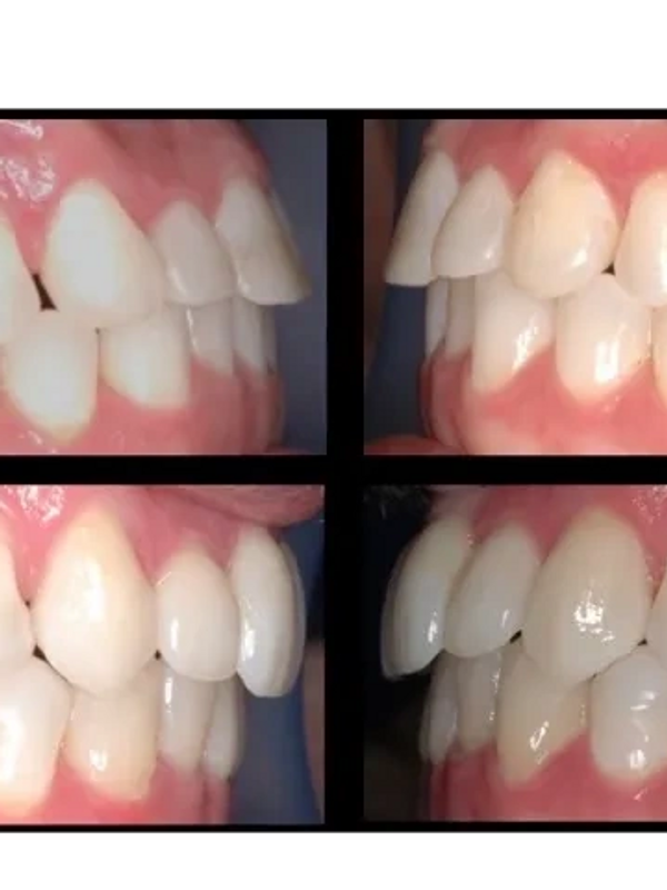 Before & After showing the differences in anterior guidance design and tooth form found in nature.