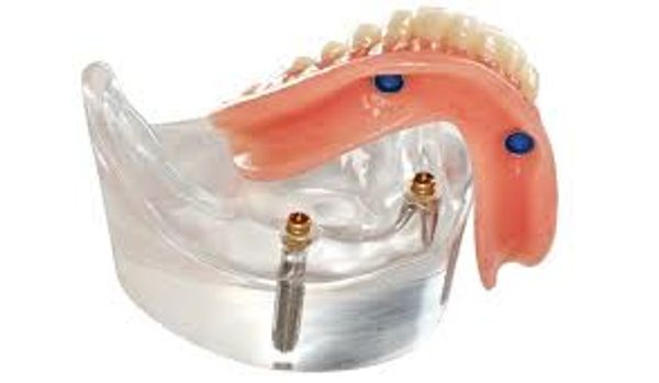 IMPLANT DENTURES denture service at PRESTON DENTURES Melbourne