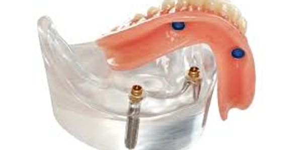 Implant Dentures, Precision Dentures, 324 High St Preston PRESTON DENTURES Ph 9041  6443 