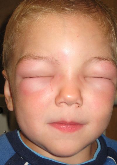 angioedema, swollen face, puffy eyelids in a child of anaphylaxis