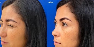 Side-by-side before and after images showing reduced wrinkles around the eyes after treatment.
