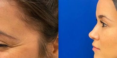 Before and after images showing facial skin improvement and wrinkle reduction.