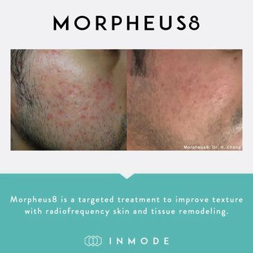 Morpheus 8 for acne scarring in Newport Beach 