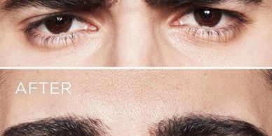 Jeuveau Injections
Wrinkle Treatment in the Newport Beach Area
