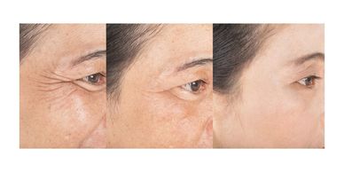 Pre and Post Botox instructions 
