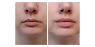 Before and after lip enhancement showing fuller lips.