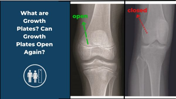 X-ray comparison showing open and closed growth plates in knees.