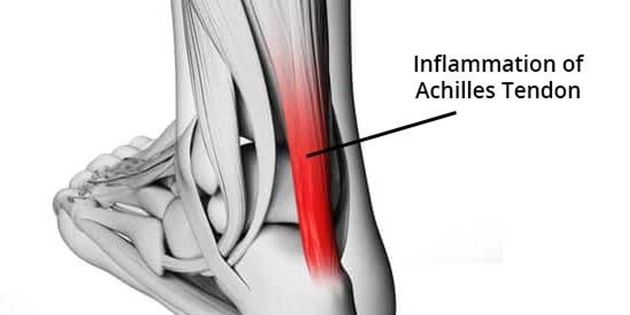 Inflamed on sale achilles tendon