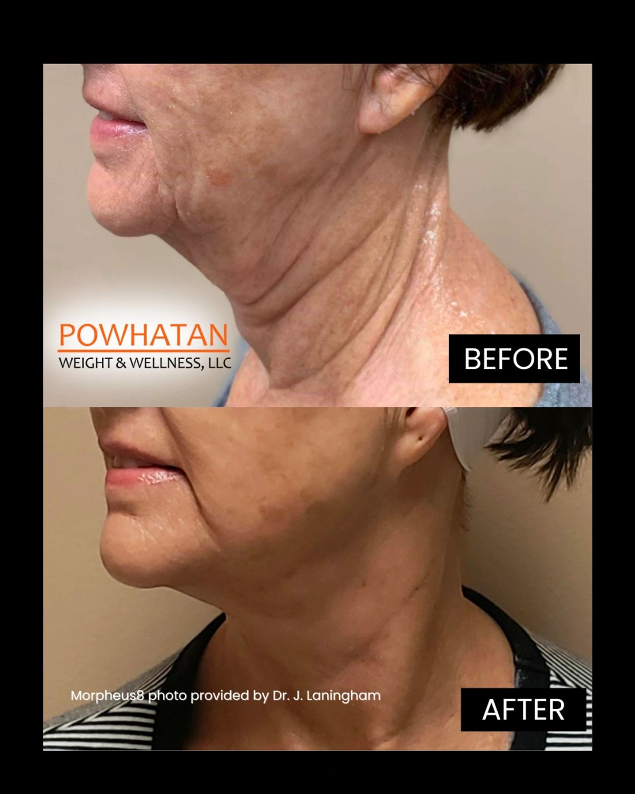 Before and after neck skin tightening treatment.