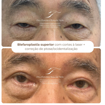 Blefaroplastia