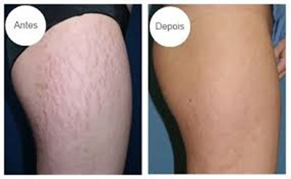 Antes e Depois Estrias