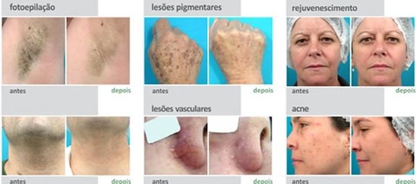 lesões pigmentares
rejuvenescimento