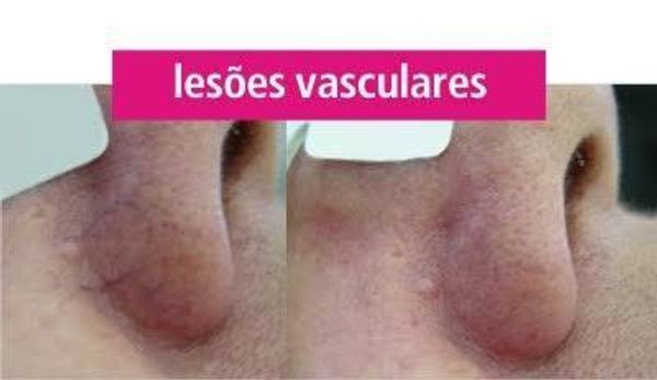 lesões vasculares