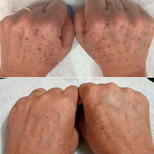 lesão mãos
mãos manchadas
manchas de mão
manchas na mão