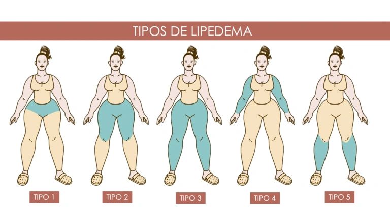 Você já ouviu falar em Lipedema?