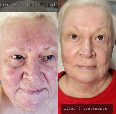 Looking years younger after facial treatments