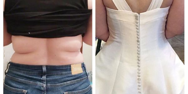Cavi-Lipo ultrasound and laser treatments for safe fat loss